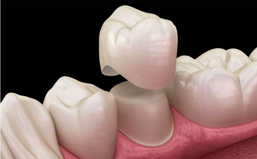 虫歯の再発リスクの軽減
