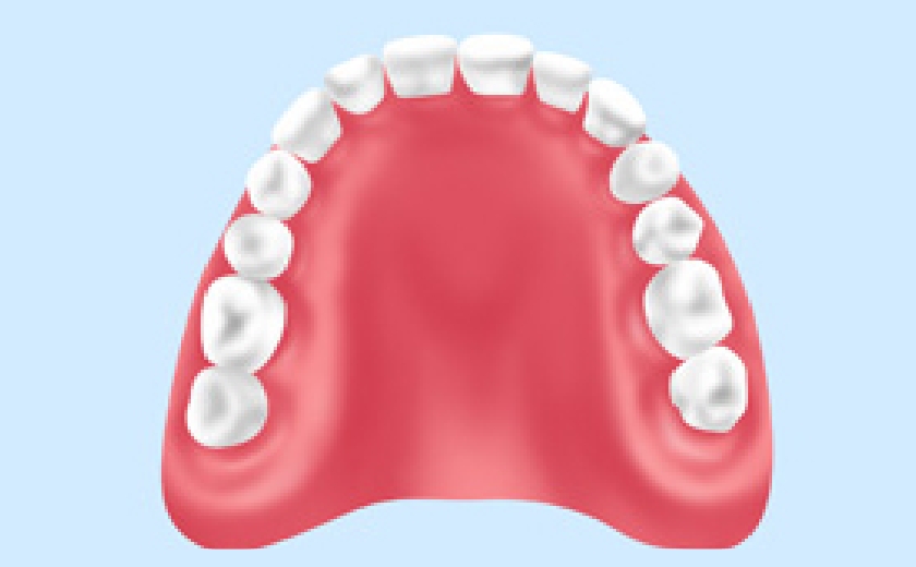 レジン床義歯