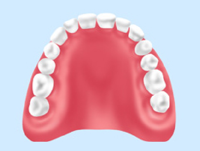 レジン床義歯
