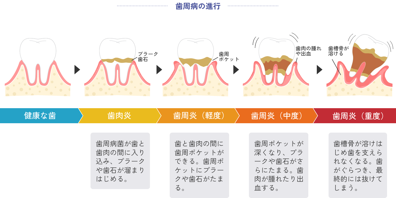 歯周病の進行