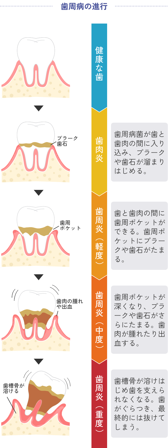 歯周病の進行