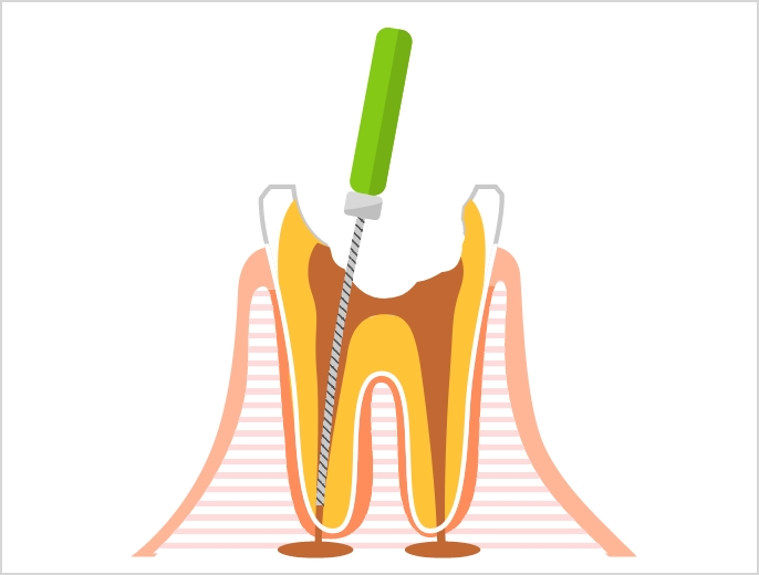正確な根管治療