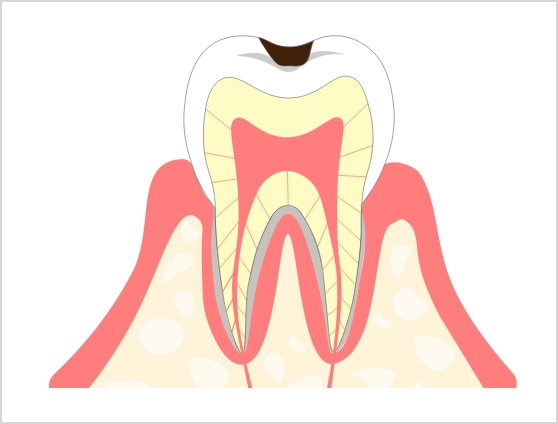 C1 エナメル質の虫歯