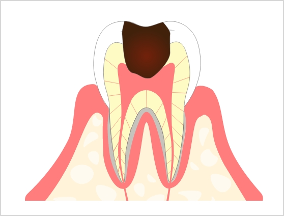 C3 神経まで達した虫歯