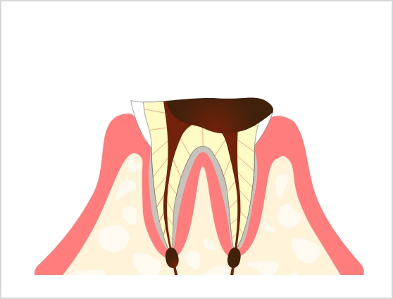 C4 歯根まで達した虫歯