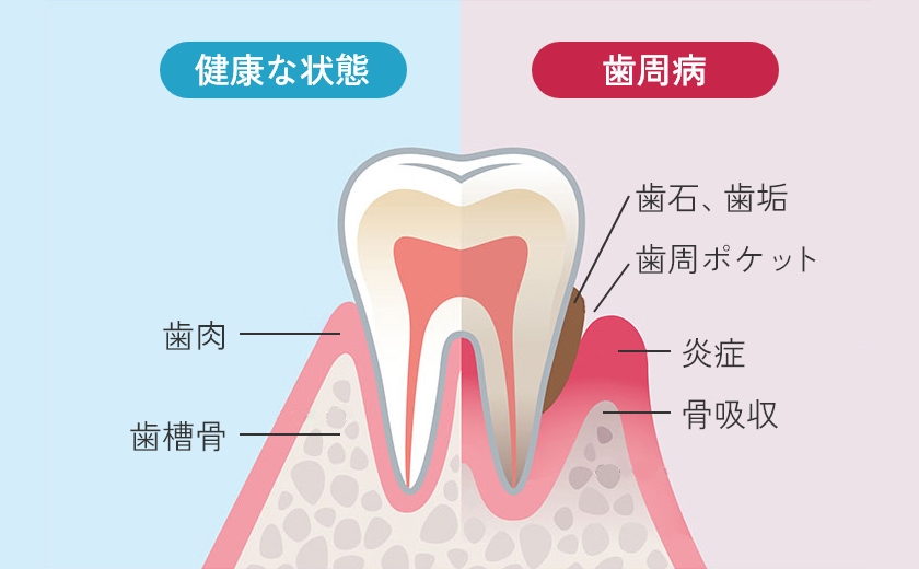 気づかないまま進行し歯を失う歯周病