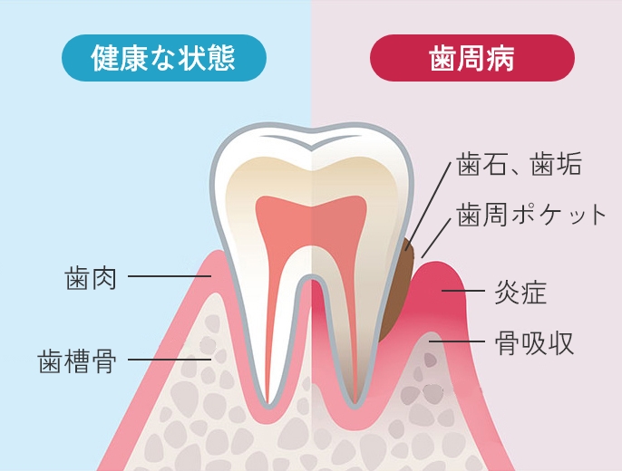 気づかないまま進行し歯を失う歯周病