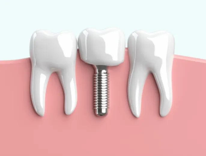 インプラント｜大津町・菊陽町の歯医者 こんどう歯科医院