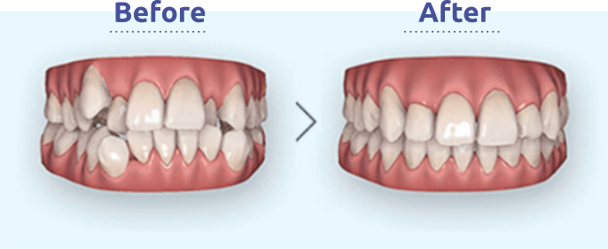 治療後の歯並びがわかる無料シミュレーション